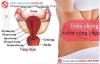 Nhận biết nhanh các dấu hiệu viêm vùng chậu nữ