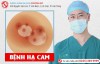 Hạ cam – căn bệnh tưởng lạ mà quen