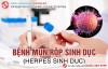 Thông tin về herpes sinh dục