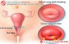 Viêm cổ tử cung: Bệnh nguy hiểm có thể gây vô sinh ở nữ giới